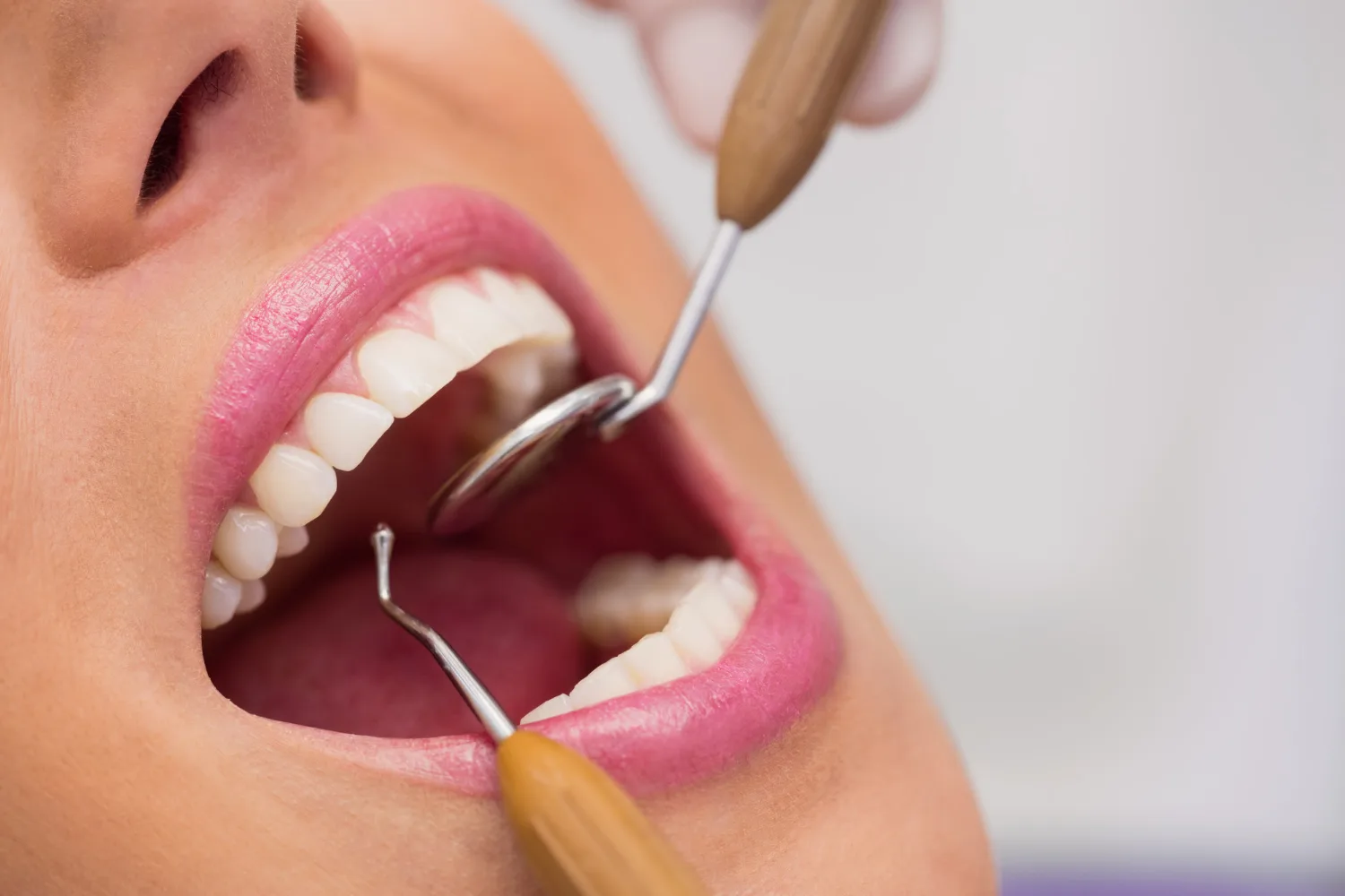 Teeth Whitening