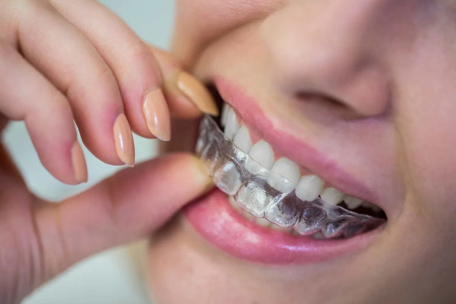 Clear aligners