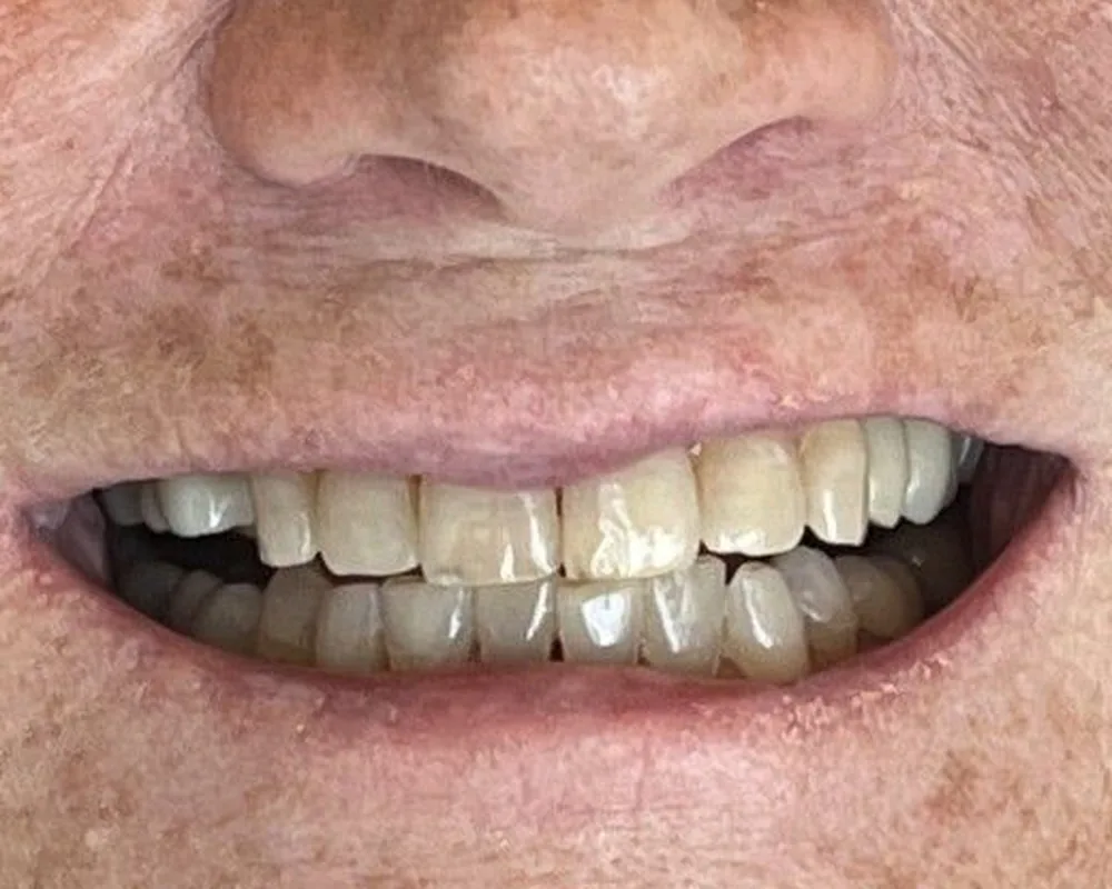 Patient smile before treatment